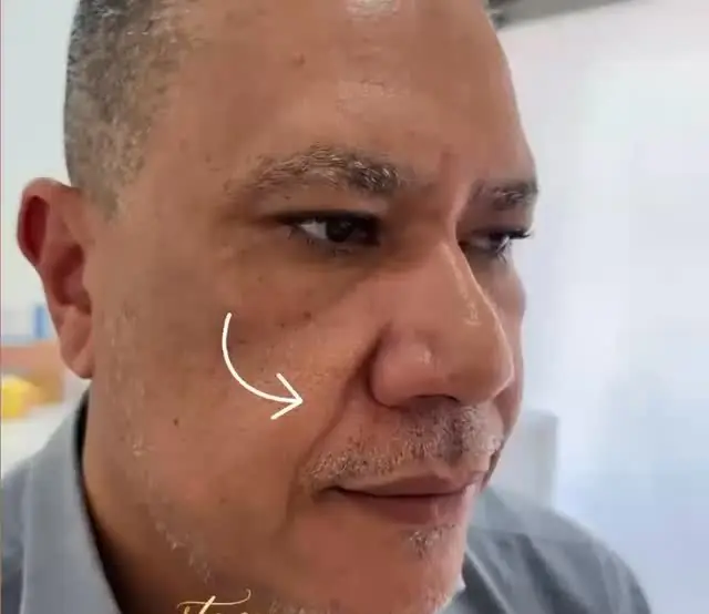 Antes: Preenchimento do bigode chinês