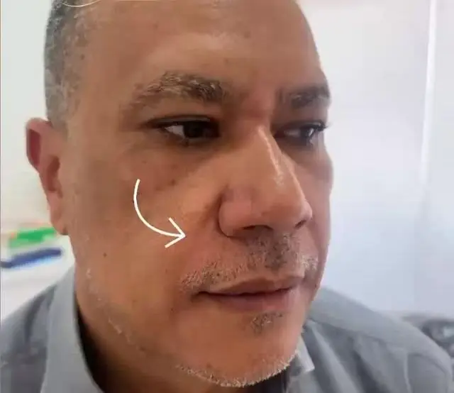 Rosto de paciente após preenchimento do bigode chinês na Stacie