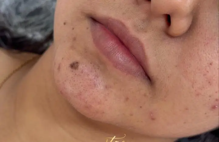 Antes: Preenchimento labial