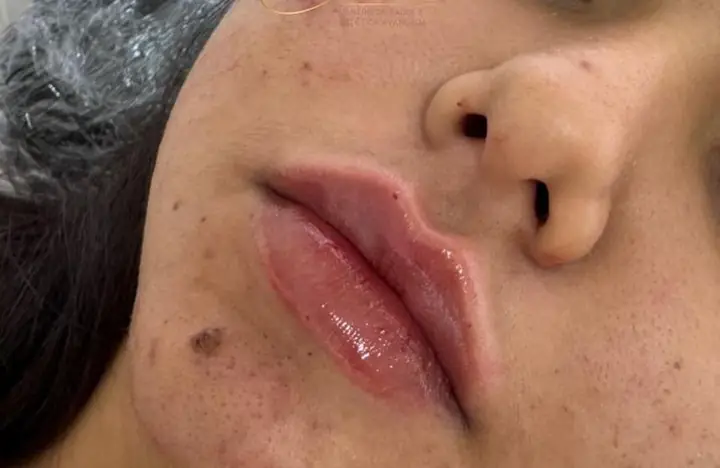 Lábios de paciente após preenchimento labial na Stacie